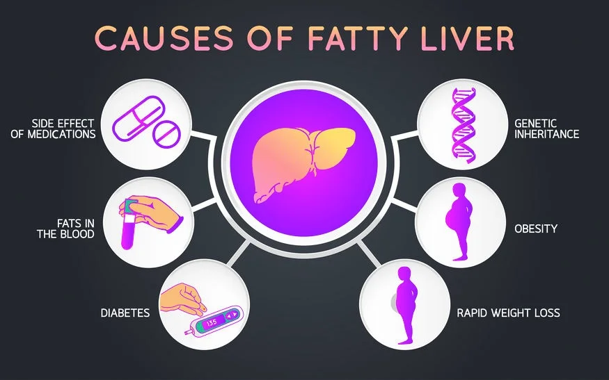Causes of Fatty Liver, natural treatment for fatty liver